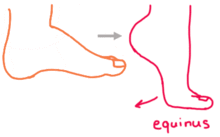Equinus Illustration.png