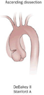 Aortic dissection of DeBakey type II.png