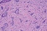 Morpheaform basal-cell carcinoma.jpg