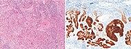 BCC with squamous cell metaplasia with HE and BerEP4 staining.jpg