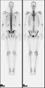 Nl bone scan2.jpg