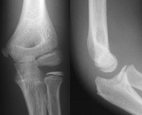 Ap lateral elbow.jpg