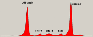 Monoclonal gammopathy Multiple Myeloma.png