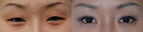 East Asian blepharoplasty before after.jpg