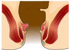 Piles Grade 1.svg