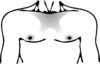 14 - Circumareolar-pecto-infraclavicular.png