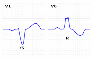 Left bundle branch block ECG characteristics.svg