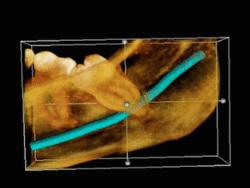 3D CT impacted wisdom tooth.Gif