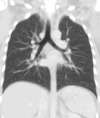 Coronal average intensity projection CT thorax.gif