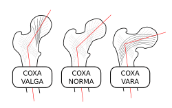 Coxa-valga-norma-vara-000.svg