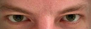 Mydriasis due to LSD usage.jpg