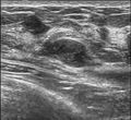 Breast US Fibroadenoma 0531092019656 Nevit.jpg