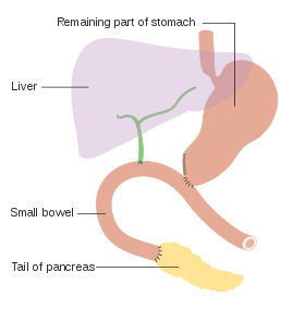 Diagram showing how the pancreas and bowel is joined back together after a Whipple's operation CRUK 140.svg
