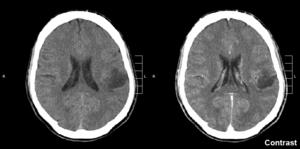 Glioma.gif