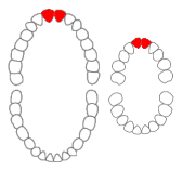 Maxillary central incisors01-01-06.png