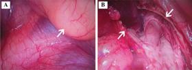 Video accociated thoracoscopy of mediastinal tumor.png