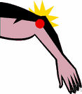 urarthritis - a painful inflammation of the big toe and foot caused by defects in uric acid metabolism resulting in deposits of the acid and its salts in the blood and joints