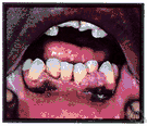 ulemorrhagia - bleeding of the gums