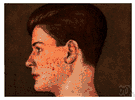 acne rosacea - a skin disease of adults (more often women) in which blood vessels of the face enlarge resulting in a flushed appearance