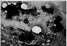 malignant melanoma - any of several malignant neoplasms (usually of the skin) consisting of melanocytes