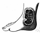 ulcer - a circumscribed inflammatory and often suppurating lesion on the skin or an internal mucous surface resulting in necrosis of tissue