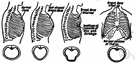 chicken breast - abnormal protrusion of the breastbone caused by rickets