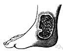 leishmaniasis americana - a form of leishmaniasis endemic in Mexico and Central American and South America