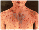 morbilli - an acute and highly contagious viral disease marked by distinct red spots followed by a rash