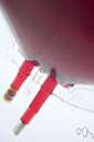 vascular hemophilia