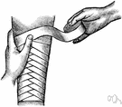 binding - the act of applying a bandage