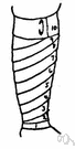 spiral bandage - an oblique bandage in which successive turns overlap preceding turns