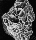 pulmonary emphysema - an abnormal condition of the lungs marked by decreased respiratory function