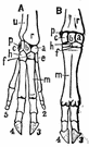 os hamatum - the wrist bone in line with the 4th and 5th fingers