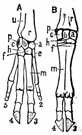 Unciform bone - the wrist bone in line with the 4th and 5th fingers