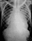 consumption - involving the lungs with progressive wasting of the body