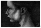 epidemic parotitis - an acute contagious viral disease characterized by fever and by swelling of the parotid glands