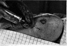 needle biopsy - biopsy of deep tissue that is obtained through a hollow needle
