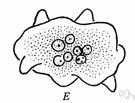 amebic dysentery - inflammation of the intestines caused by Endamoeba histolytica