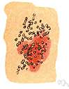 molluscum contagiosum - a virus disease of the skin marked by round white swellings
