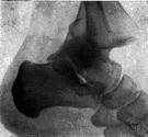 talus - the bone in the ankle that articulates with the leg bones to form the ankle joint