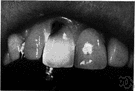 putrefaction - (biology) the process of decay caused by bacterial or fungal action