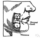 tooth socket - a bony socket in the alveolar ridge that holds a tooth