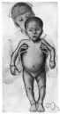 avitaminotic - of or relating to or characteristic of avitaminosis