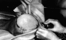 brain surgery - any surgical procedure involving the brain