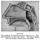 adenoidectomy - surgical removal of the adenoids