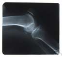 arthrography - roentgenographic examination of a joint after injection of radiopaque contrast medium