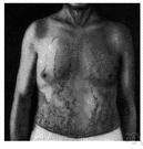 varicosis - pathological condition of being varicose or having varicose veins