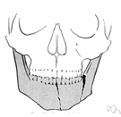 break - breaking of hard tissue such as bone