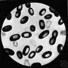 pestis bubonica - the most common form of the plague in humans
