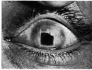 corneal graft - a surgical procedure in which part or all of a damaged or diseased cornea is replaced by healthy corneal tissue from a donor